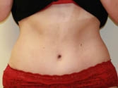 Feel Beautiful - Tummy Tuck Case 3 - After Photo